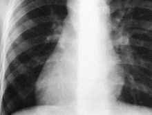Больной туберкулезом распространял заразу среди турковцев