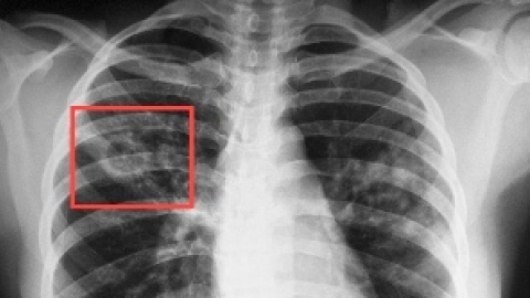 «Фтизиатры на страже здоровья»: Как в столице сражаются с туберкулезом