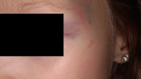 Маленькая девочка получила синяк на лице из-за гололеда. Видео