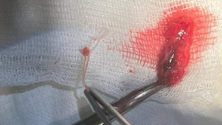 Саратовские врачи вытащили червя из лица пациента