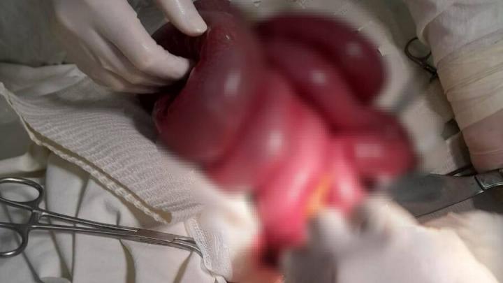 Балаковские хирурги  провели непростую операцию 